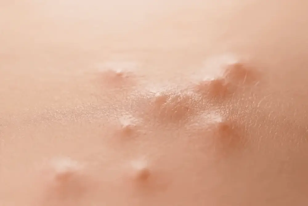 [여드름기능성] 동아제약 아크네 프로 겔제 30ml 상세페이지 17